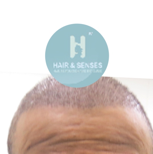 Hairline Designing 2800